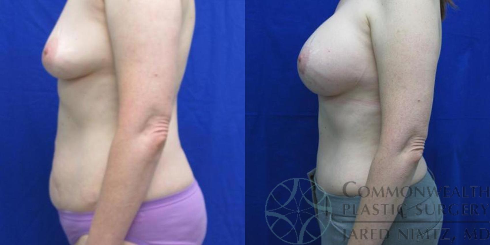 Before & After Tummy Tuck Case 38 View #3 View in Lexington & London, KY