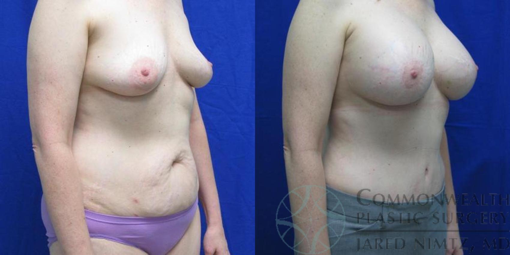 Before & After Tummy Tuck Case 38 View #4 View in Lexington & London, KY