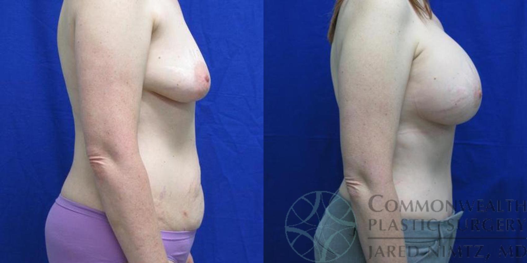 Before & After Tummy Tuck Case 38 View #5 View in Lexington & London, KY