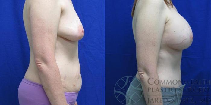 Before & After Breast Augmentation Case 38 View #5 View in Lexington & London, KY