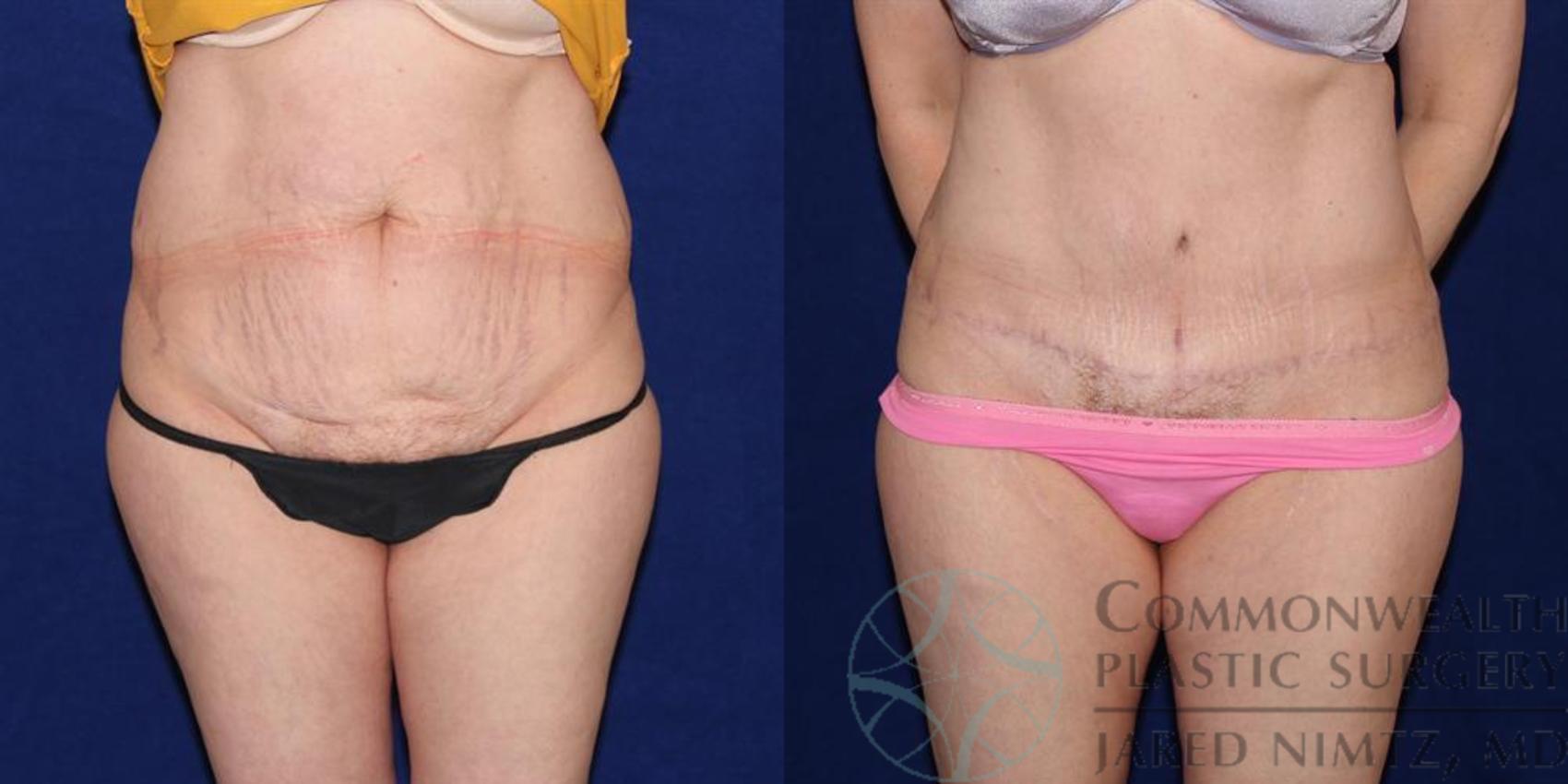 Tummy Tuck Case 39 Before & After View #1 | Lexington & London, KY | Commonwealth Plastic Surgery