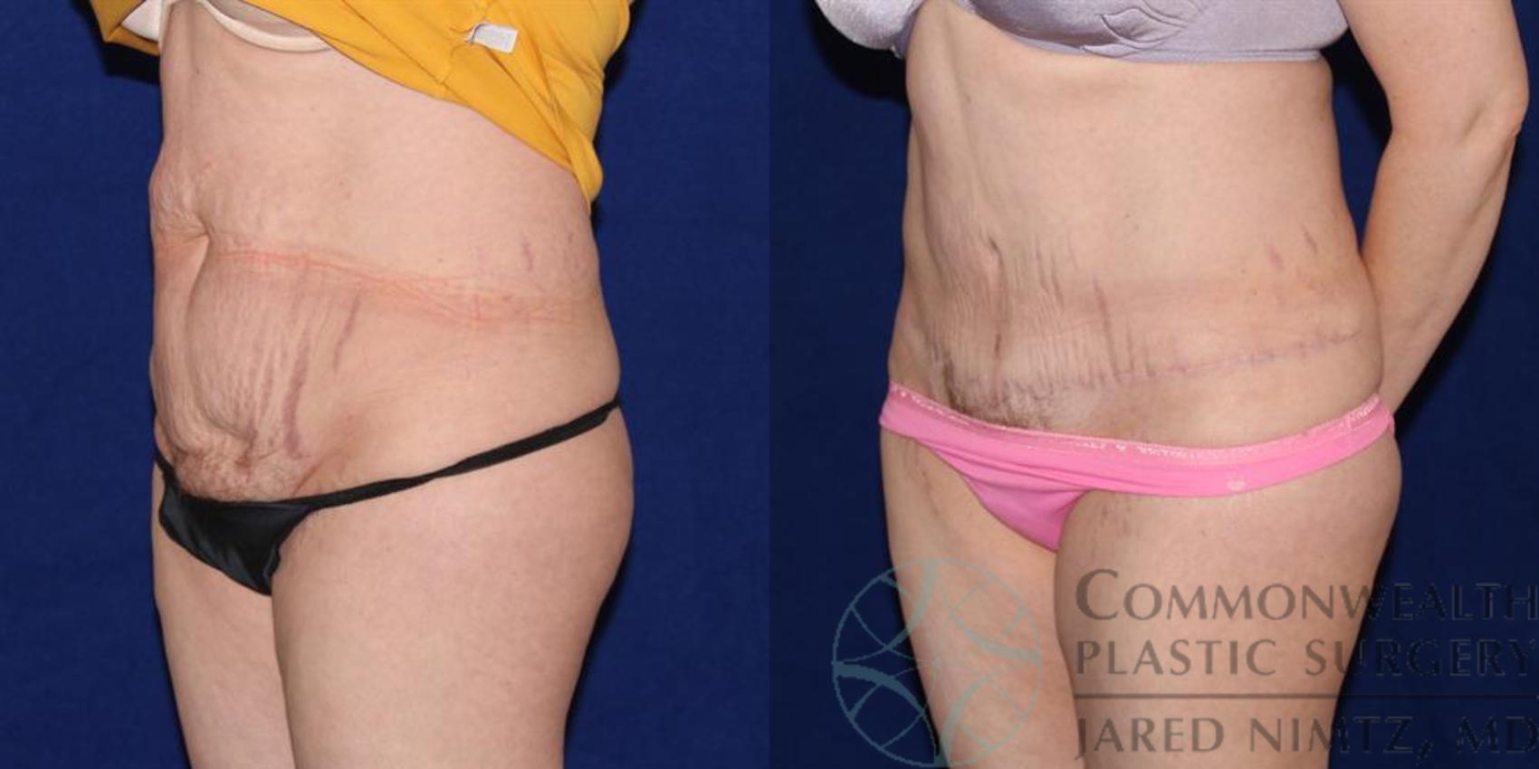 Before & After Tummy Tuck Case 39 View #2 View in Lexington & London, KY