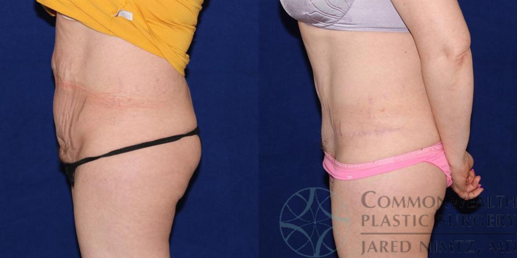 Before & After Tummy Tuck Case 39 View #3 View in Lexington & London, KY