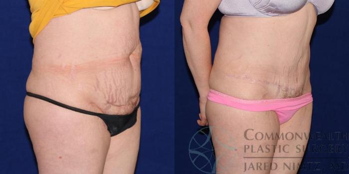 Before & After Tummy Tuck Case 39 View #4 View in Lexington & London, KY
