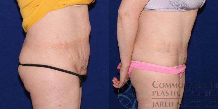 Before & After Tummy Tuck Case 39 View #5 View in Lexington & London, KY