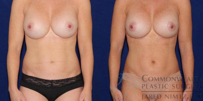 Before & After Tummy Tuck Case 40 View #1 View in Lexington & London, KY