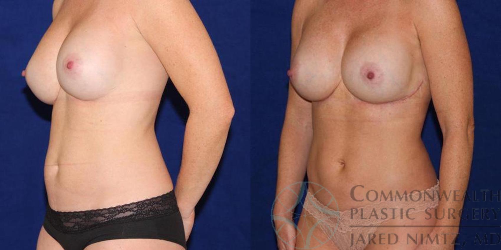 Before & After Tummy Tuck Case 40 View #2 View in Lexington & London, KY