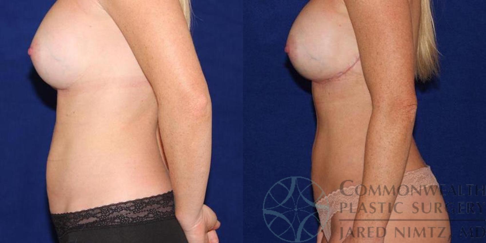 Before & After Tummy Tuck Case 40 View #3 View in Lexington & London, KY