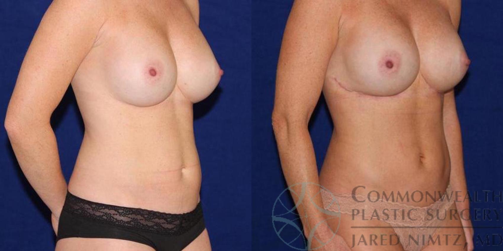 Before & After Tummy Tuck Case 40 View #4 View in Lexington & London, KY
