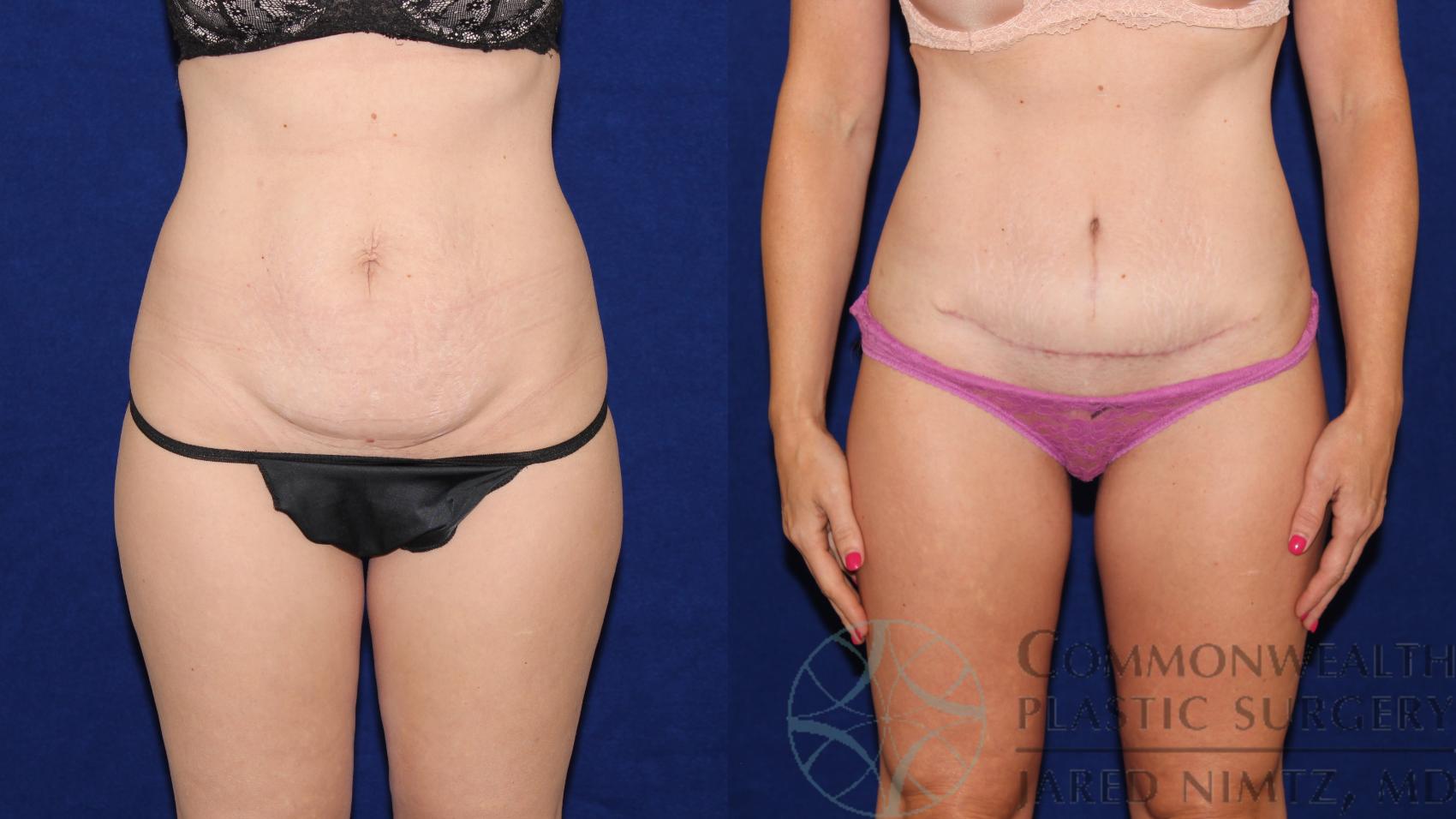 Before & After Tummy Tuck Case 66 View #1 View in Lexington & London, KY