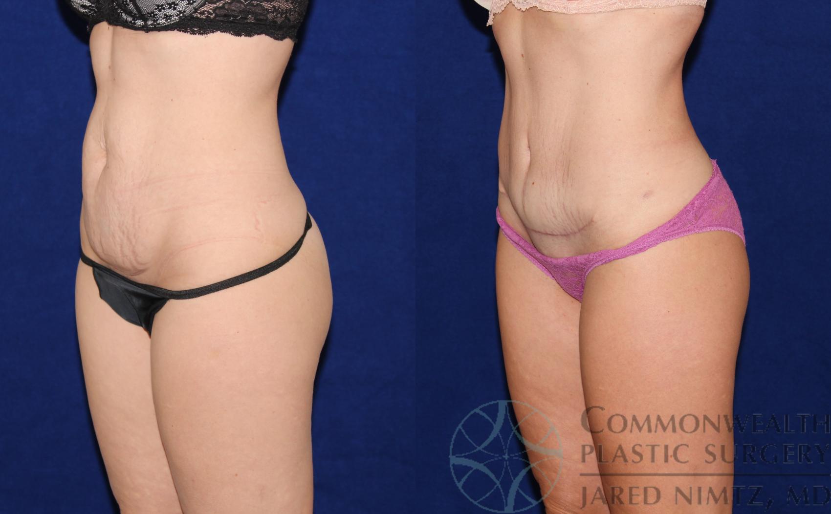 Before & After Tummy Tuck Case 66 View #2 View in Lexington & London, KY