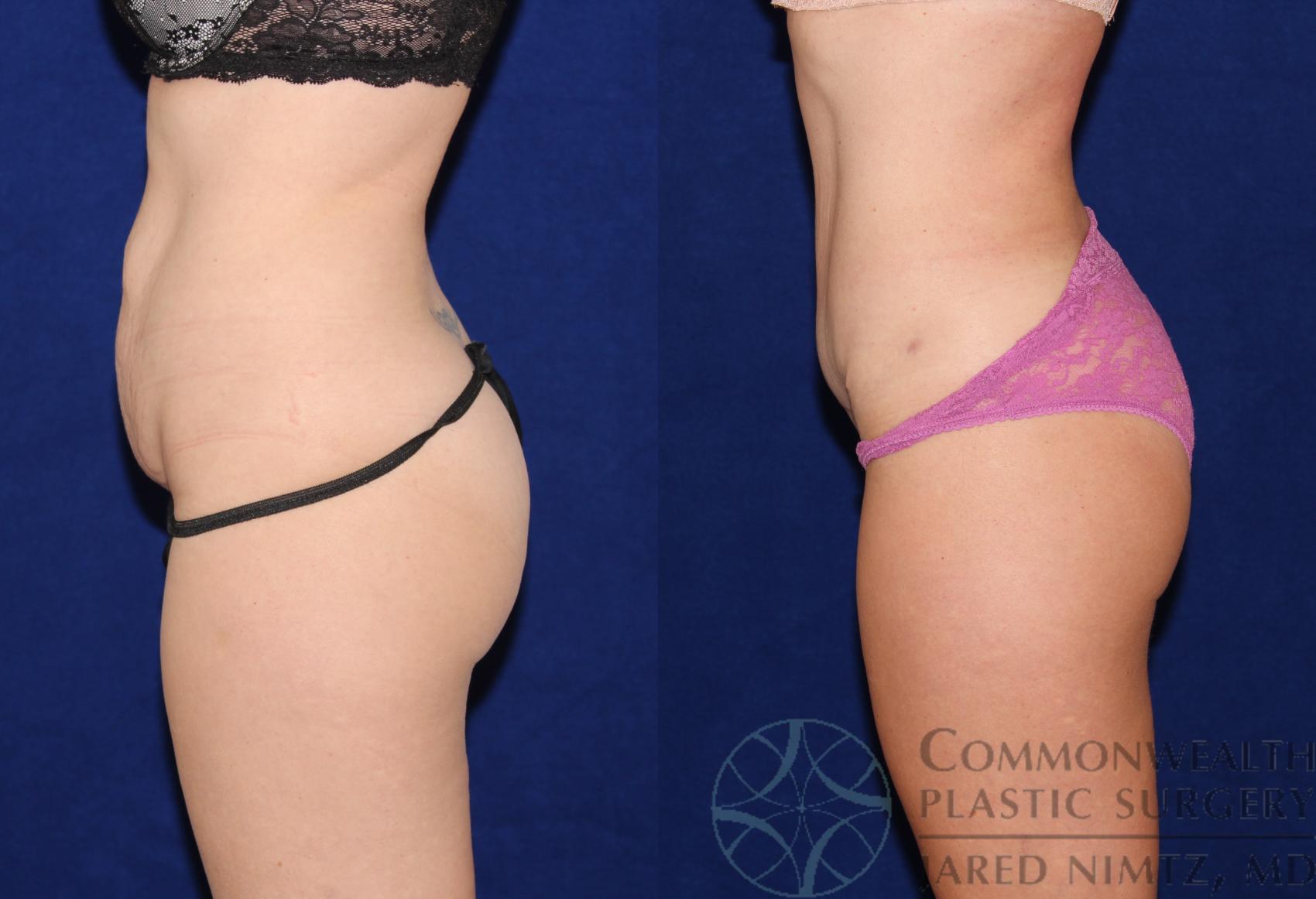 Before & After Tummy Tuck Case 66 View #3 View in Lexington & London, KY