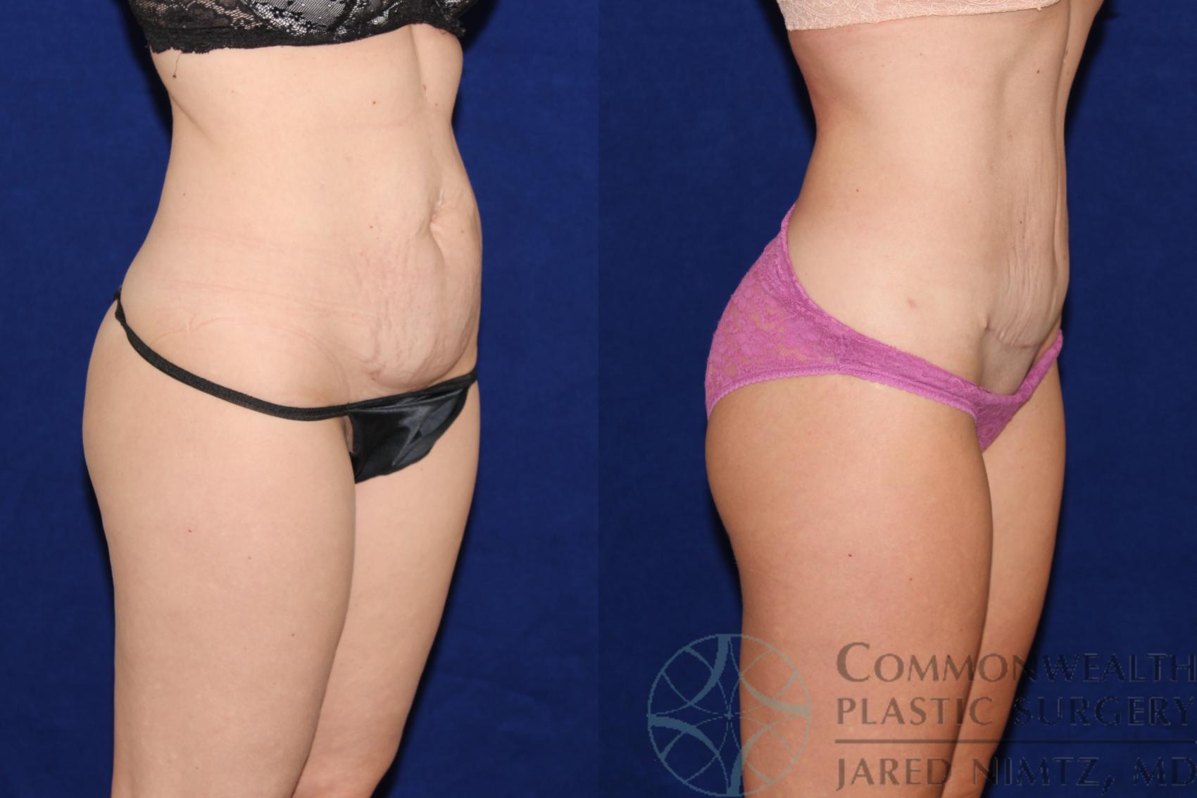 Before & After Tummy Tuck Case 66 View #4 View in Lexington & London, KY