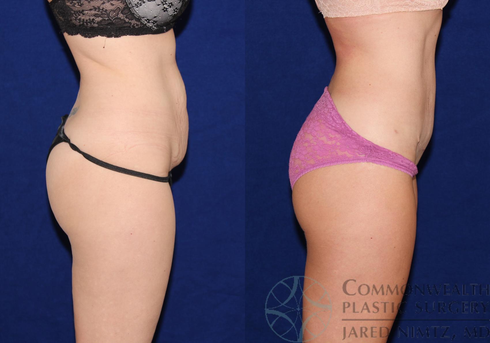 Before & After Tummy Tuck Case 66 View #5 View in Lexington & London, KY