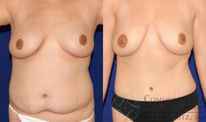 Before & After Tummy Tuck Case 67 View #1 View in Lexington & London, KY