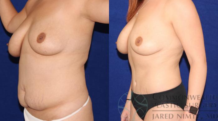 Before & After Tummy Tuck Case 67 View #2 View in Lexington & London, KY