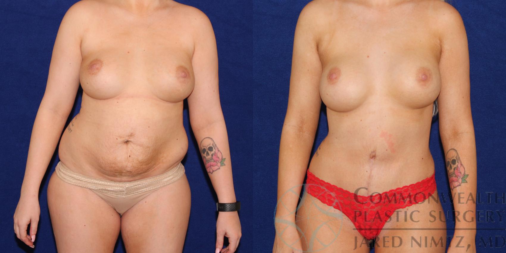 Before & After Tummy Tuck Case 73 View #1 View in Lexington & London, KY