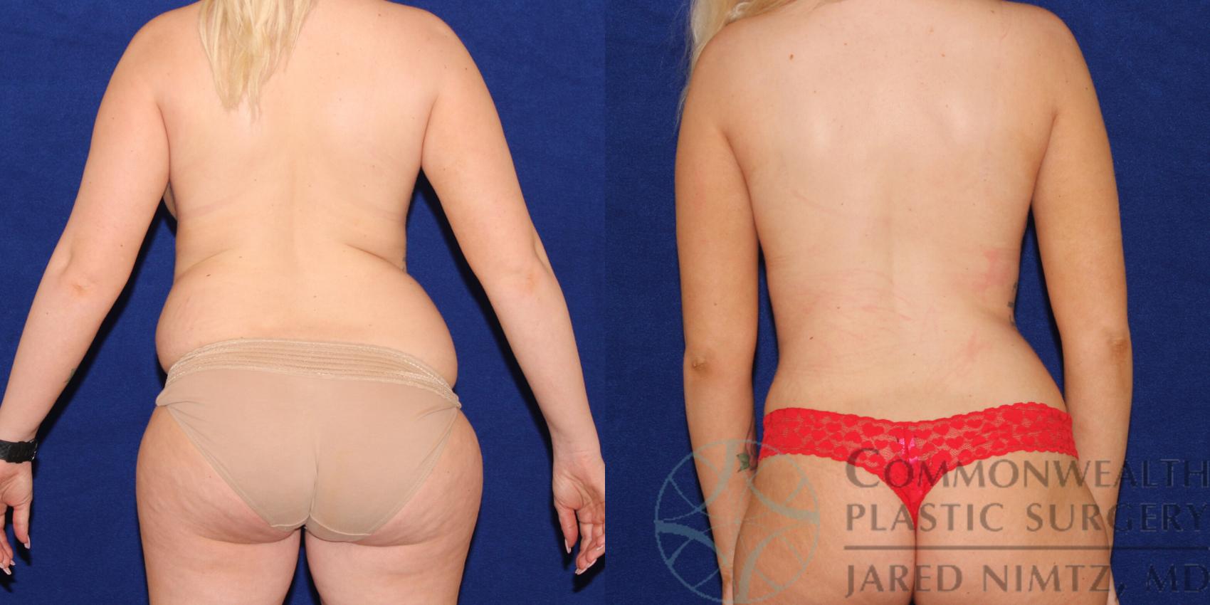 Before & After Tummy Tuck Case 73 View #2 View in Lexington & London, KY