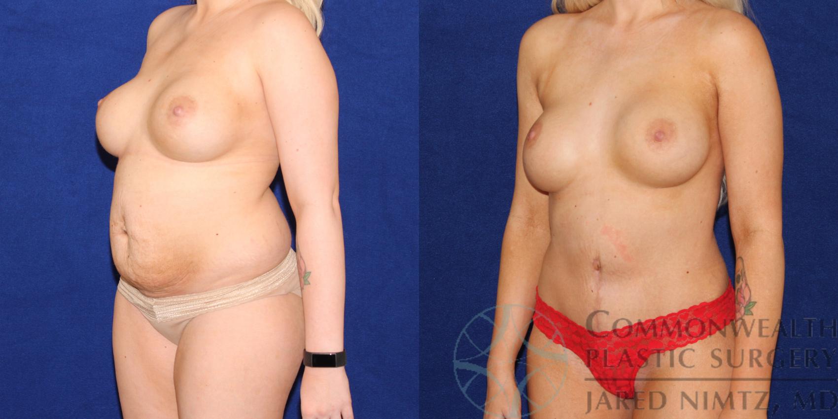 Before & After Tummy Tuck Case 73 View #3 View in Lexington & London, KY