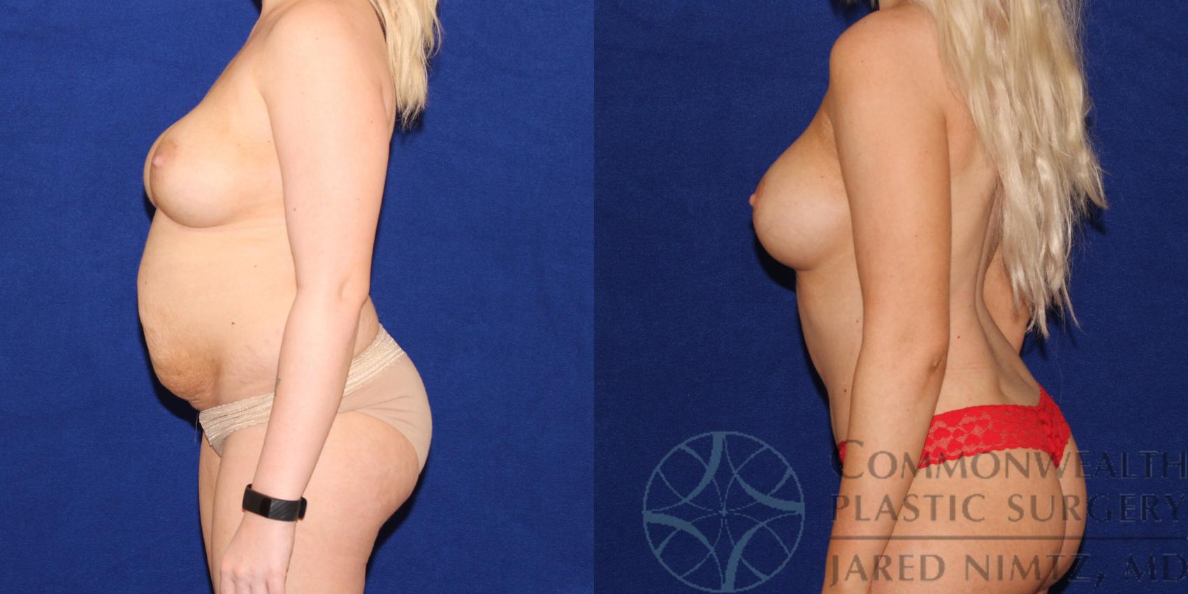Before & After Tummy Tuck Case 73 View #4 View in Lexington & London, KY