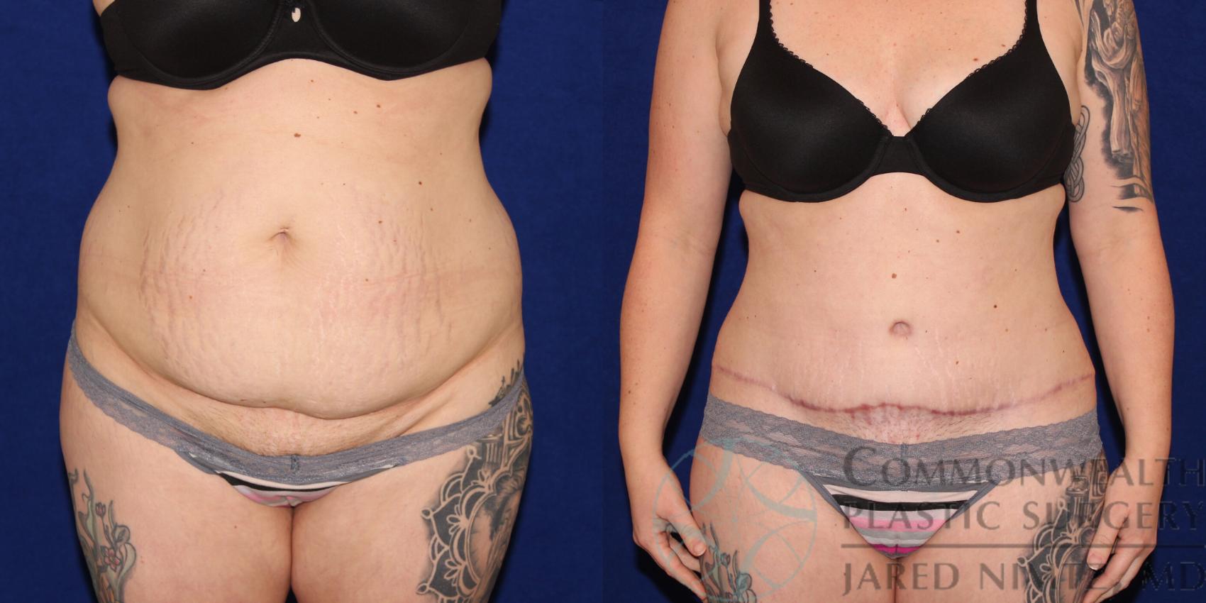 Before & After Tummy Tuck Case 80 View #1 View in Lexington & London, KY