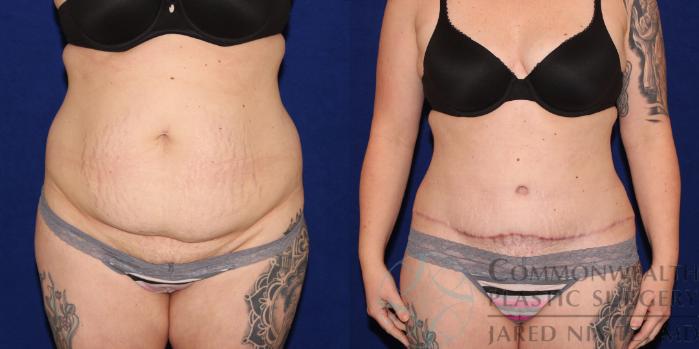 Before & After Post Weight Loss Contouring Case 80 View #1 View in Lexington & London, KY