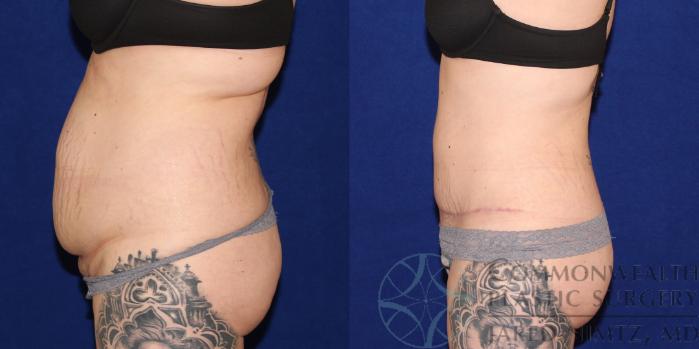 Before & After Tummy Tuck Case 80 View #3 View in Lexington & London, KY