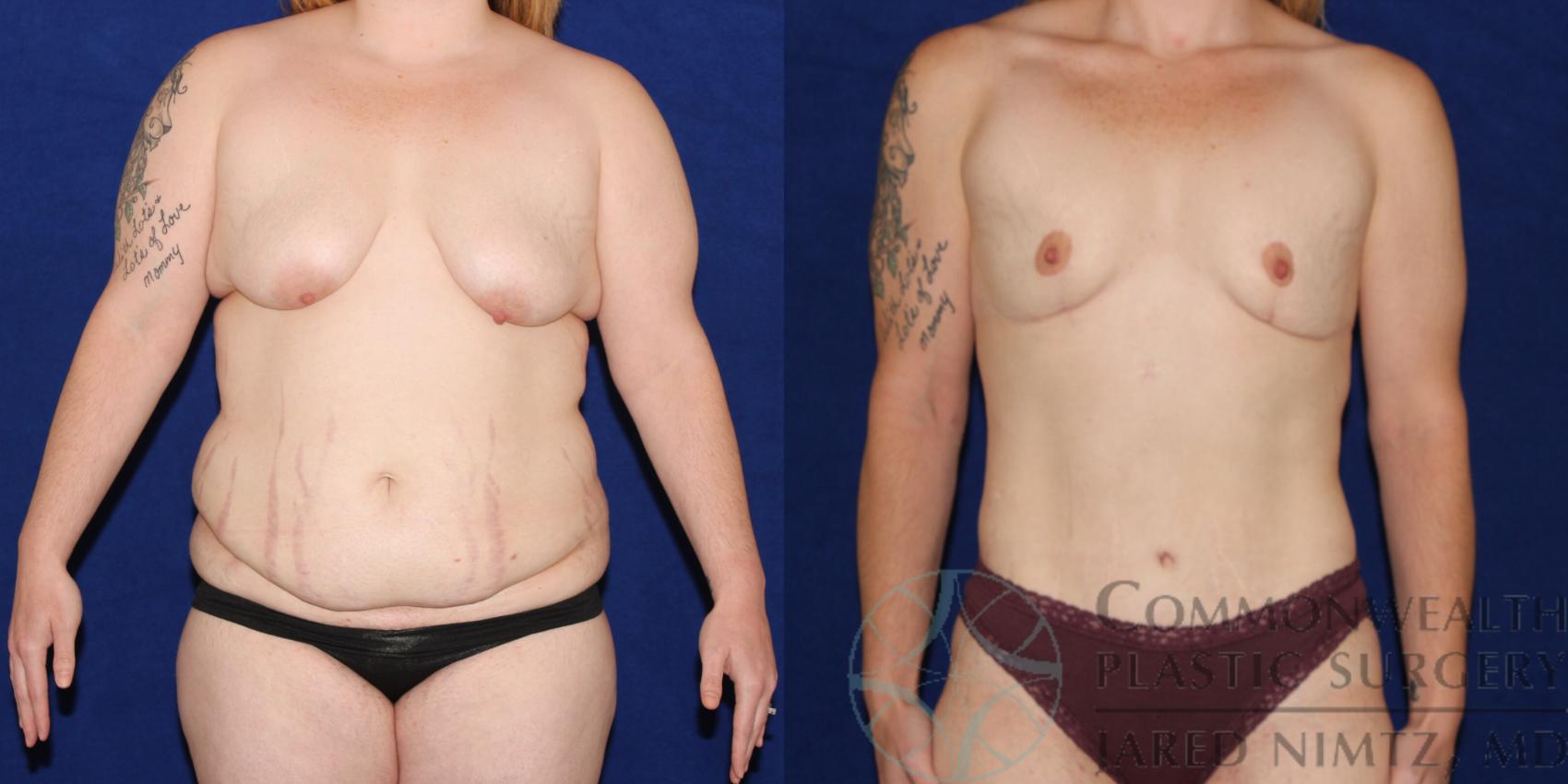 Tummy Tuck in Louisville & Lexington, KY