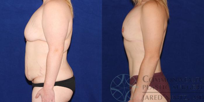 Before & After Breast Lift Case 83 View #2 View in Lexington & London, KY
