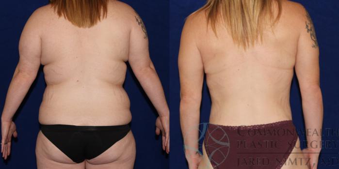 Before & After Post Weight Loss Contouring Case 83 View #3 View in Lexington & London, KY